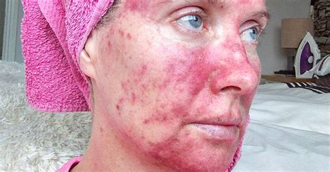 Actinic keratosis: Woman shows treatment with painful photos