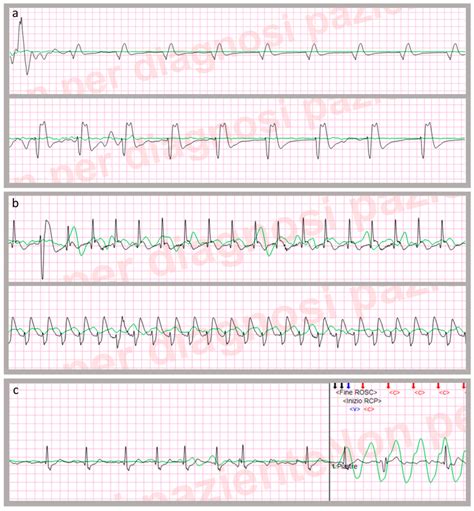 a. Examples of pulseless electrical activity (PEA) in two different ...