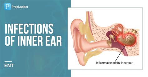 Infections of Inner Ear: Labyrinthitis, Vestibular Neuritis, Causes ...