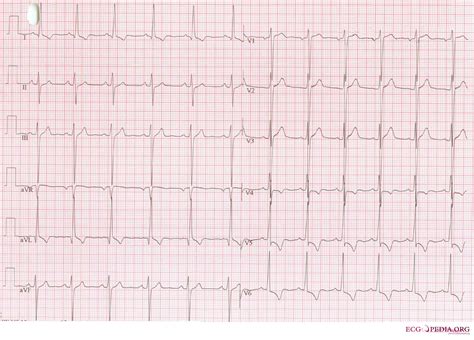 Left ventricular hypertrophy electrocardiogram - wikidoc