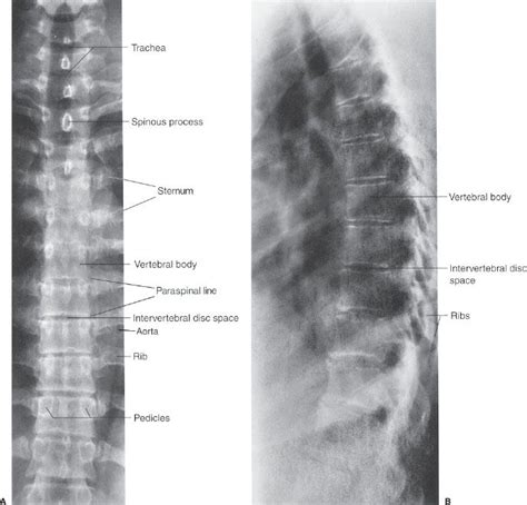 9 Spine and Pelvis | Radiology Key