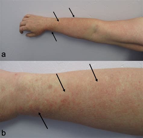 Cureus | Doxycycline-Associated Dual Cutaneous Adverse Reaction to the ...