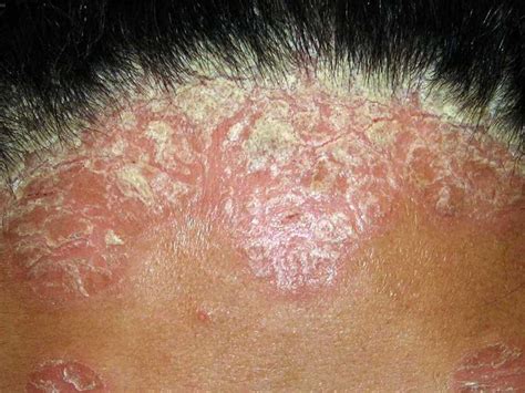 Scalp psoriasis: Pictures, symptoms, and treatment