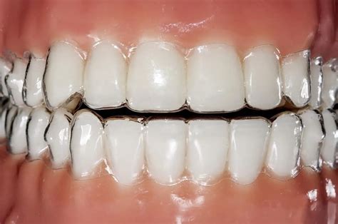 invisalign on teeth - Dentaly.org