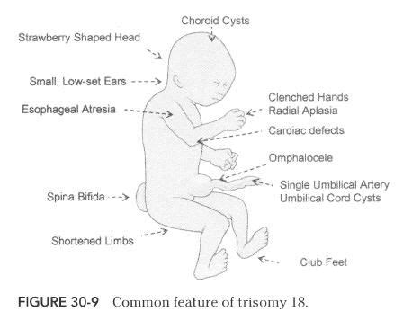 10 best images about Trisomy 18 (Edwards Syndrome) on Pinterest ...