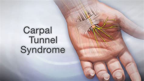 Diseases That Cause Wrist Pain, Its Risk Factors and How To Prevent It ...