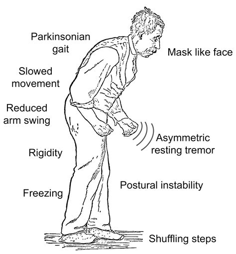 Parkinson's: four unusual signs you may be at risk