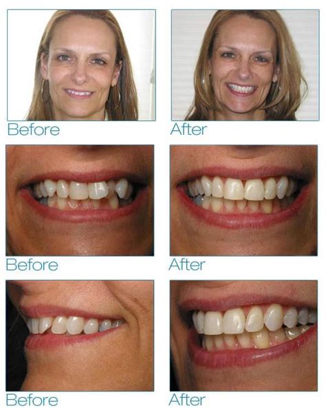 Six Month Smiles in Brooklyn - EnvySmile Dental Spa