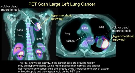 Xrays and CT Scans of Lung Cancer