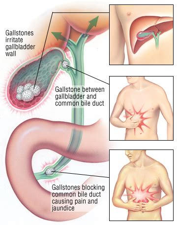 Bile Duct Diseases - Harvard Health