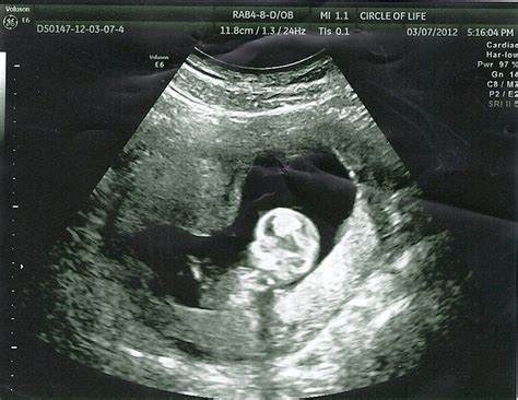 It's A Cardall Thing...: My 3 Month Ultrasound