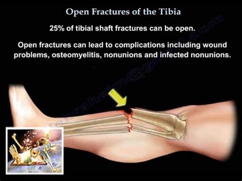 Leg Fracture - Symptoms, Swelling And Treatment Of Open And Closed Leg ...