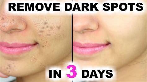 In 3 DAYS - Remove Dark Spots, Black Spots & Acne Scars - ArtsyCraftsyDad