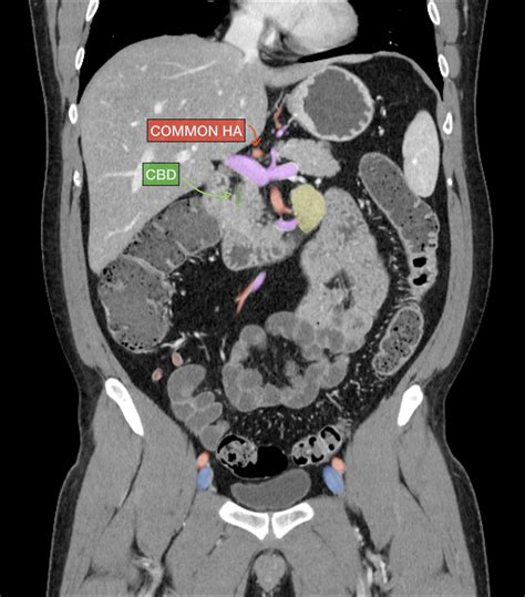 Normal Ct Scan Abdomen