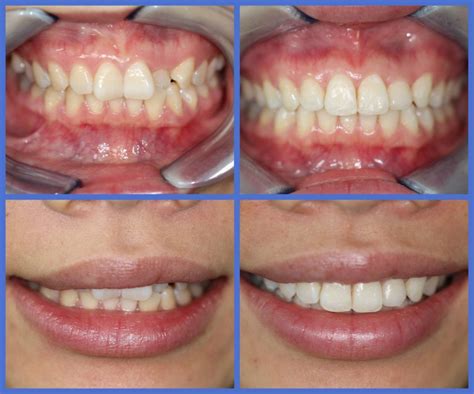 Teeth Treat: How much does laser teeth whitening cost uk