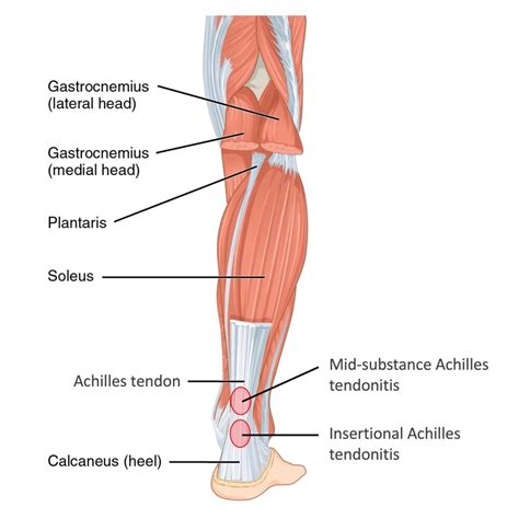 Achilles Tendonitis — Daniel Bohl, MD | Midwest Orthopaedics at RUSH