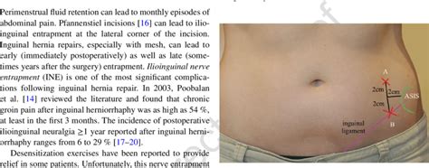 Iliac Crest Pain Syndrome