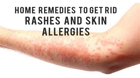 Home Remedies to get rid of Rashes and Skin Allergies - YouTube