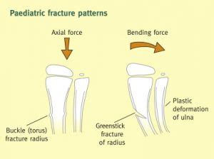 Greenstick Fracture Treatment