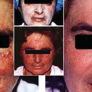 -Pacient A, granulomatous rosacea with 14-year-long development ...