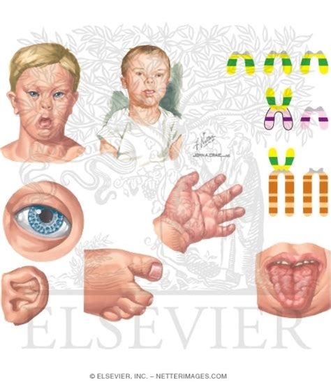 Trisomy 21 (Down Syndrome)