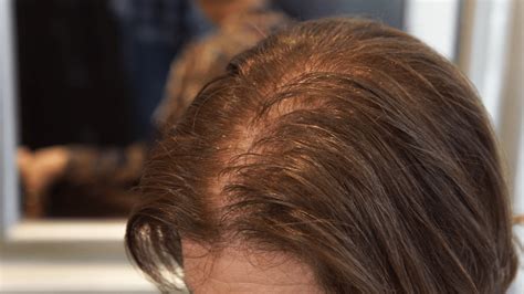 What To Do With Thin Hair : Hair Thinning Get To The Root Of The ...