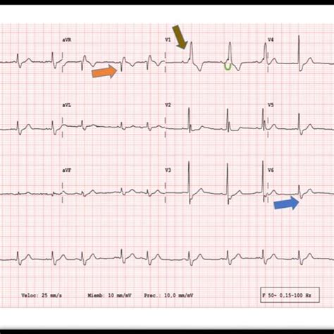 Pathological Q Wave