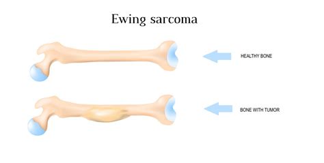 Ewing Sarcoma Tumor Survival Rate