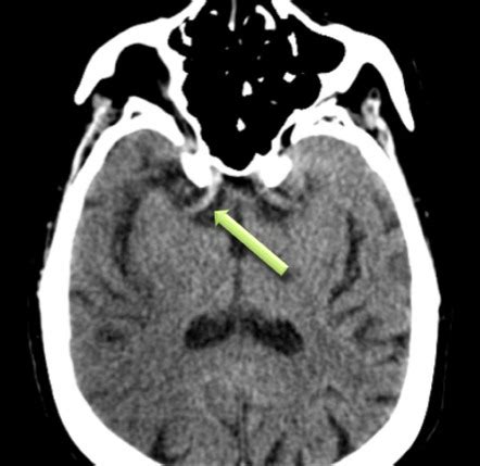 Hyperdense MCA sign | Radiology Case | Radiopaedia.org