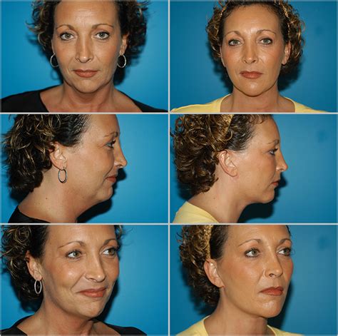 Before and After Plastic Surgery: Neck Lift | Naples Plastic Surgery