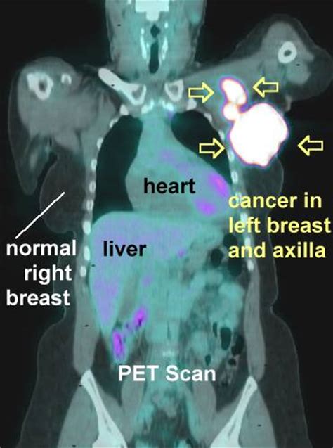 PET Scans in Cancer Cases