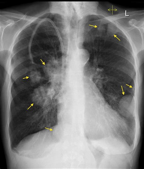 Lung metastases - breast cancer - Radiology at St. Vincent's University ...