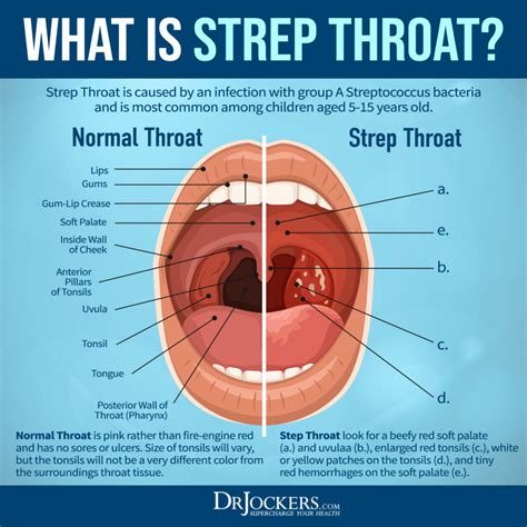 Strep Throat: Symptoms and 15 Natural Support Strategies