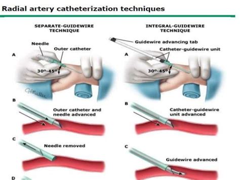 Arterial lines by Dr.Tinku Joseph