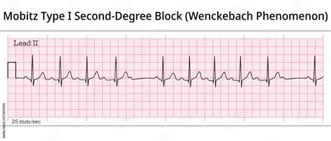 Wenckebach Phenomenon - ECG Mobitz Type 1 Second Degree Atrioventricular Block - 2nd degree AV ...