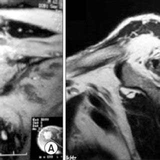 (A) Coronal oblique MRI showing a massive rotator cuff tear. (B ...