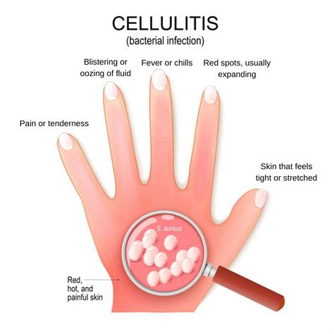 Cellulitis: Causes, Risk Factors, Symptoms, Treatment