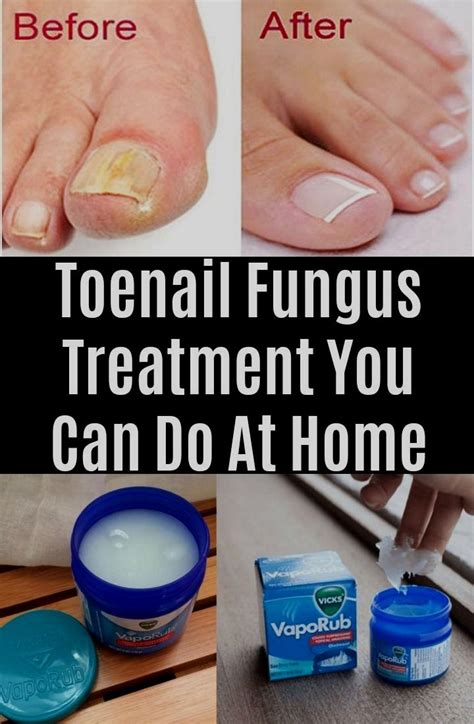 Vaseline For Nail Fungus - Nails Near Me