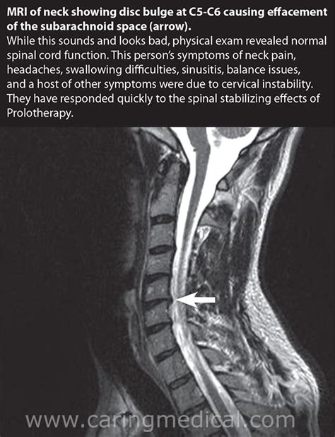 Broken Neck Mri