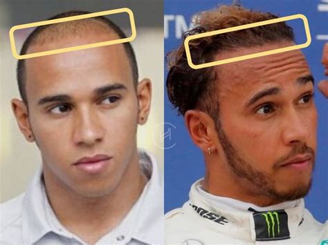 Lewis Hamilton Hair Transplant - Hair Loss & Technical Analysis