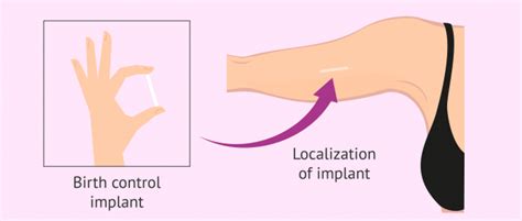 Birth Control Implant: Advantages and Disadvantages