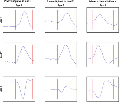 Schematic illustration of the P‐wave morphology classification. Type 1 ...