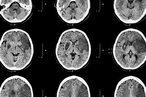 Migraine Headache and Risk for Cardiovascular and Cerebrovascular ...