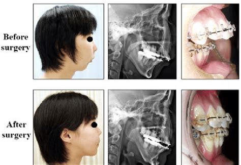 Mandible was advanced in a patient with micrognathia 0.8mm per day and ...