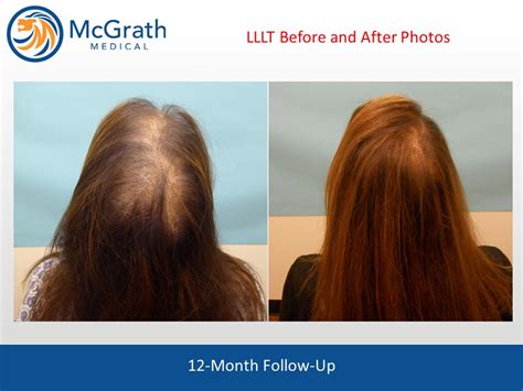 Capillus Laser Hair Therapy - Austin, TX - McGrath Medical