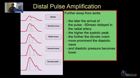 Art Line Waveform Interpretation - Get More Anythink's