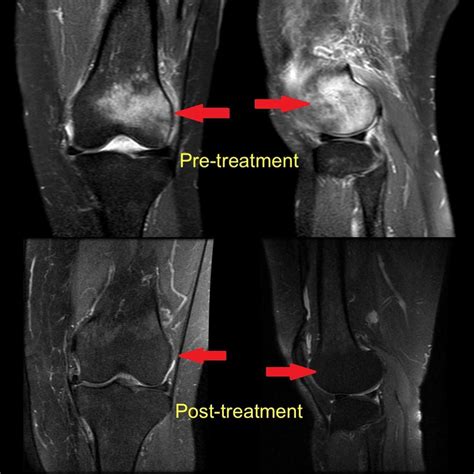 Cureus | Effectiveness of Iloprost in the Treatment of Bone Marrow Edema