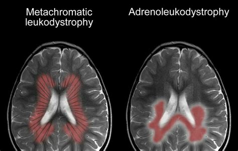 Tigroid pattern ...and leopard skin ...MLD | Cns, Radiology, Neuro