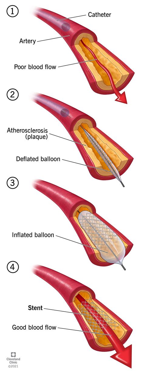 Stent In The Heart