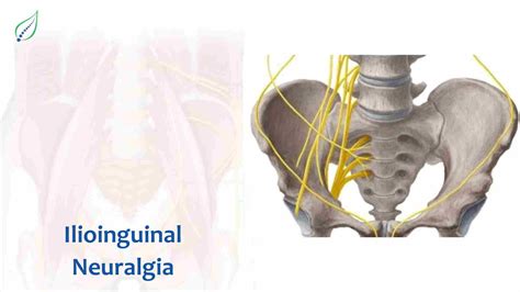 Ilioinguinal Neuralgia: Causes, Symptoms, and Treatments | Best Back ...